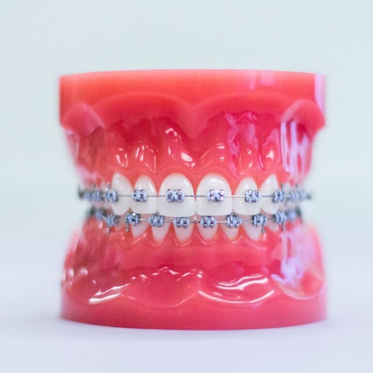 Traditional Metal Braces for Orthodontics